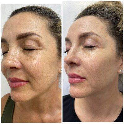 Pigmentation treatment