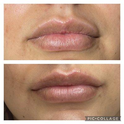 2ml needle free lip filler