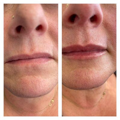 Before and After: Restylane Kysee.