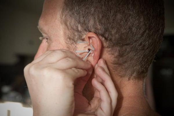 Auricular acupuncture