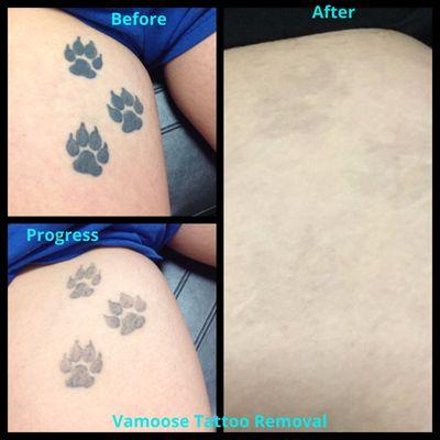 Pico Laser Tattoo Removal is all we do