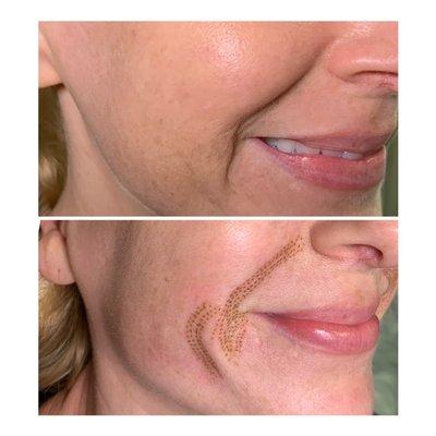 Smile line reduction, Immediately Following treatment