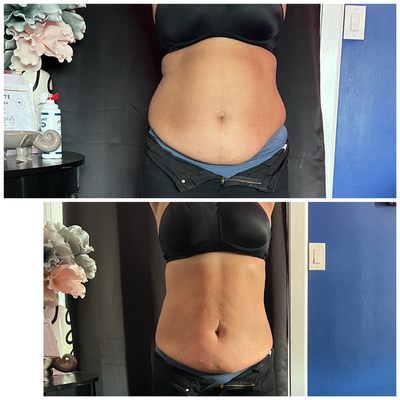 First session of body contouring