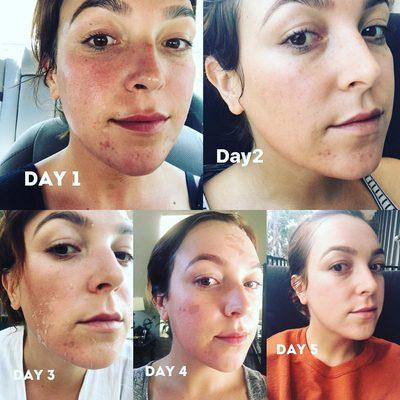 Green Peel Facial results! Get new skin in 5 days!