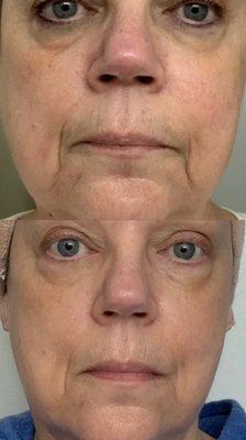 Lifting facial