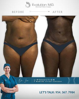 Liposuction 3 months after surgery. Amazing results!!!