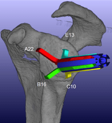 Dr. Burrus uses 3-D modeling to accurately perform shoulder replacements which improves the positioning of the implants.