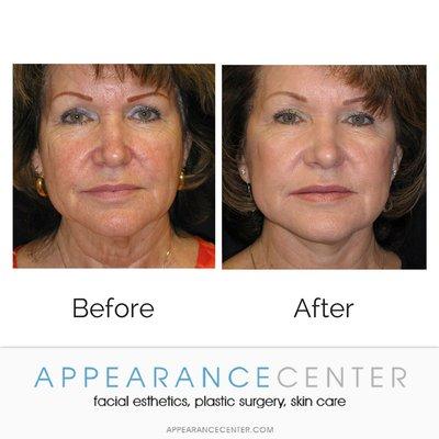 Face and Neck Lift, Skin Rejuvenation.