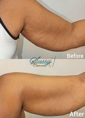 Cellulite removal on arms