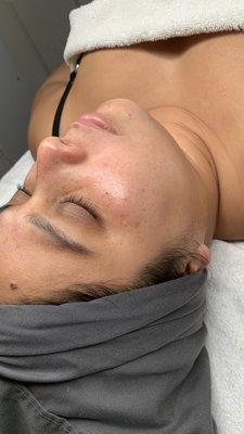 Dermaplaning Facial