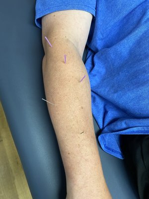 WUPT provides dry needling