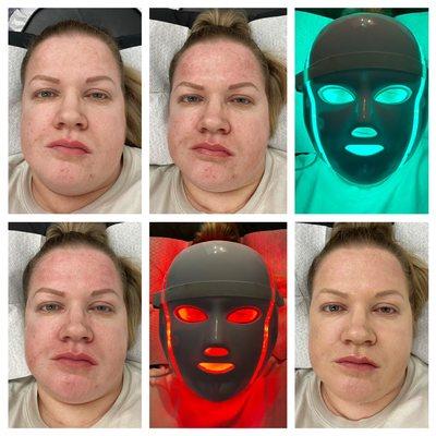 Process of BB Glow Facial Treatment