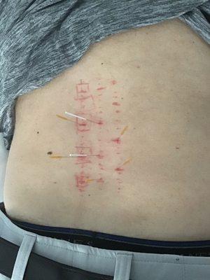 Dry Needling of the lumbar spine