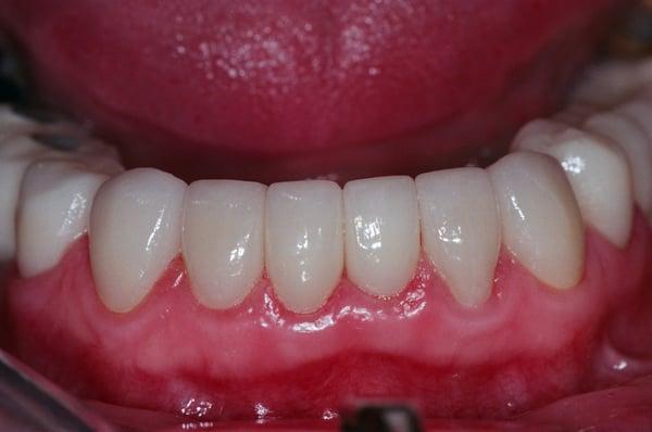 Case after treatment by Dr.Proussaefs with porcelain crowns.