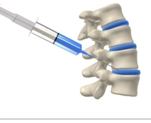 Epidural injections