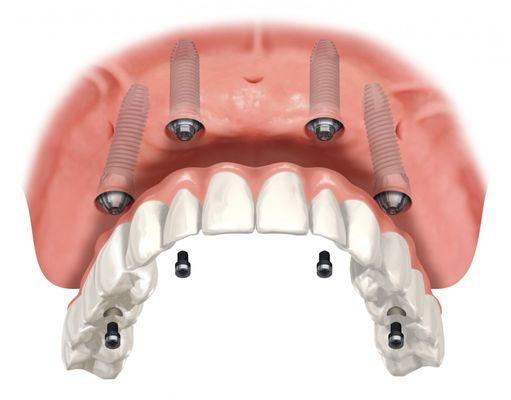 All on Four Full Arch Replacement