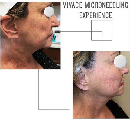 Vivace Microneedling procedure