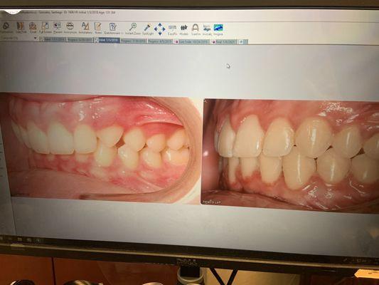 Correction of a narrow mouth and overbite