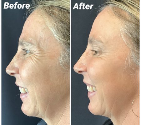 Results from Xeomin injections!