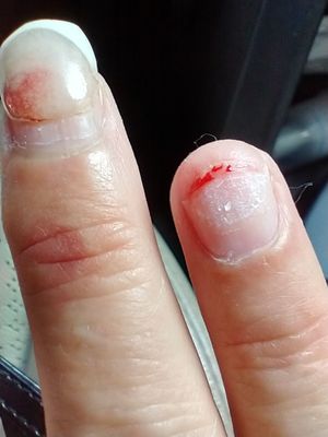 Closer view of the depth the "manicurist" cut into my nail bed with a broken piece of acrylic nail in order to remove the "fake" ones