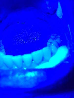 My teeth after my laser cleaning