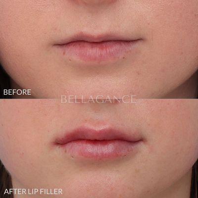 Lip filler to help increase the proportions of the lips and provide a plump but natural appearance.