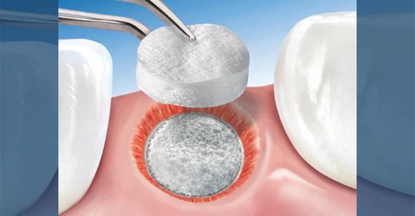 Bone Grafting and Augmentation