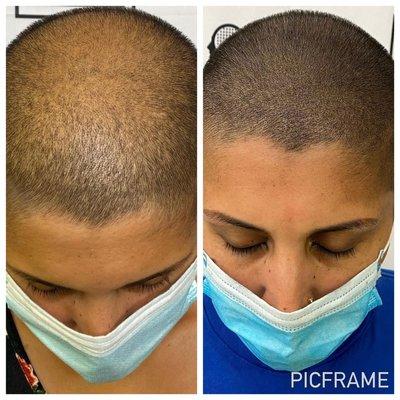 Scalp micropigmentation