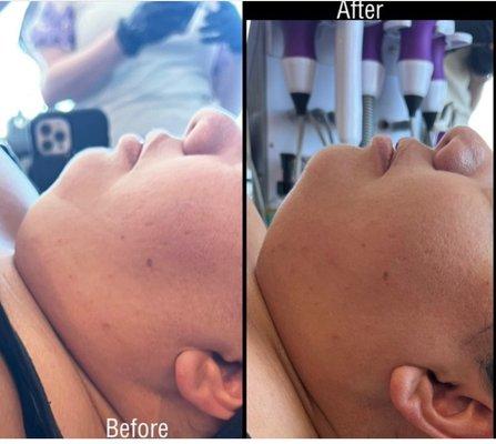 Double chin treatment same day before and after results continue 1-3 days after sessions depending on water intake , life style and habits.