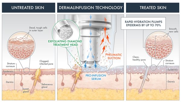 DERMAL INFUSION