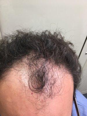 Before hair transplant