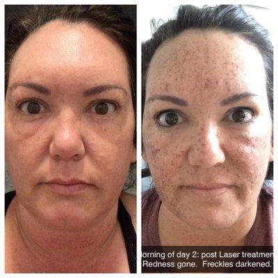 Amazing!  Freckles vanished.  This is after 1 treatment.  3 are recommended.