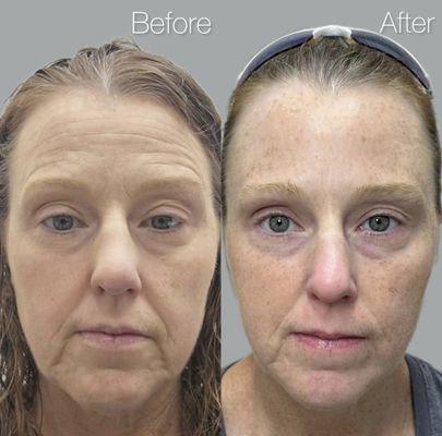 These results were achieved with just Botox. This is a first time Botox patient, I treated the upper and lower face.