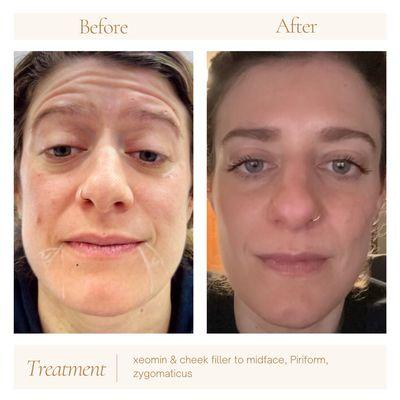 Xeomin & versa dermal filler