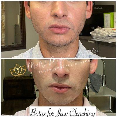 Jaw clenching treatment with BOTOX