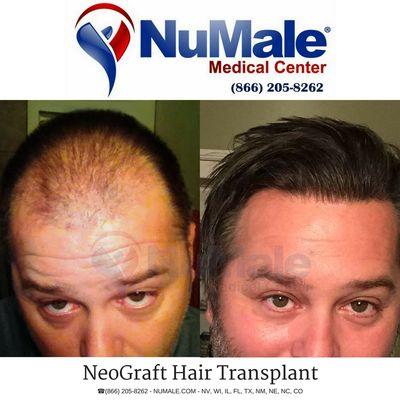 Platelet Rich Plasma (PRP) Hair Restoration Therapy for Men.