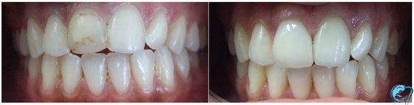 Before and After Crown on single tooth! No need to grind down two teeth to fix one bad tooth!