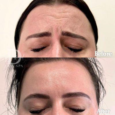 Forehead & Glabella Botox