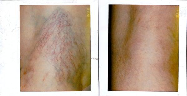 Spider veins by several sessions of sclerotherapy usually spaced two weeks apart.