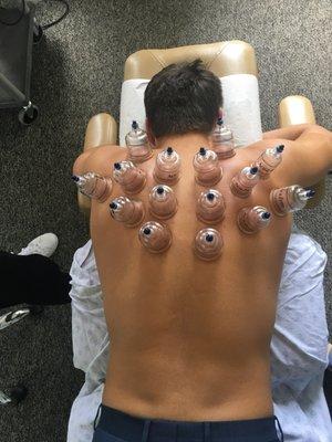 Cupping helps loosen up fascia and tight muscles. It's safe and effective. It's not painful and helps postural issues.