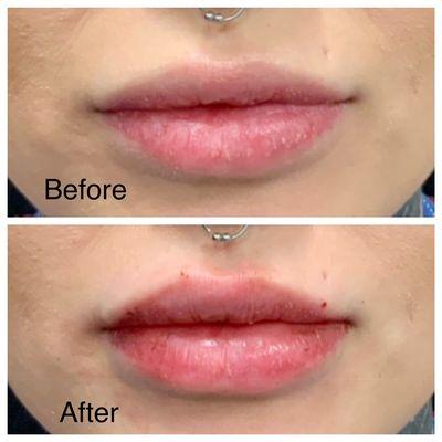 Lip augmentation with Restylane-L. Before above and Immediately after.