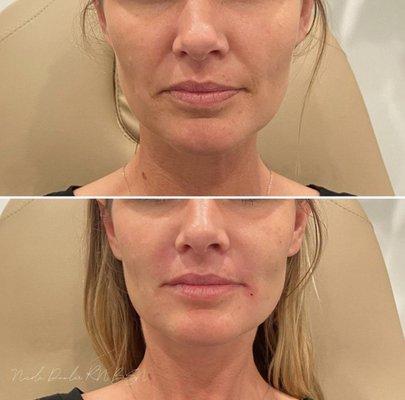 A little lower face rejuvenation! 1 syringe of filler & Botox was used to lift the midface and soften the lower face on this beauty.