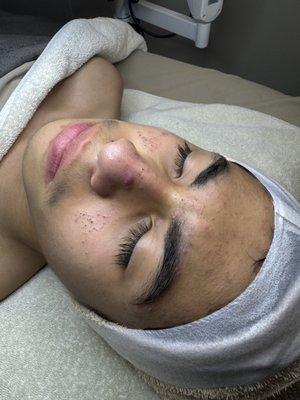 Before Deep Extraction Facial