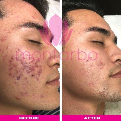 Cystic Acne Transformation