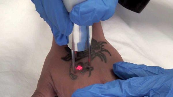 Laser Tattoo Removal