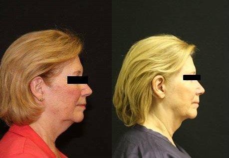 Before and after Kybella treatments to contour neck.