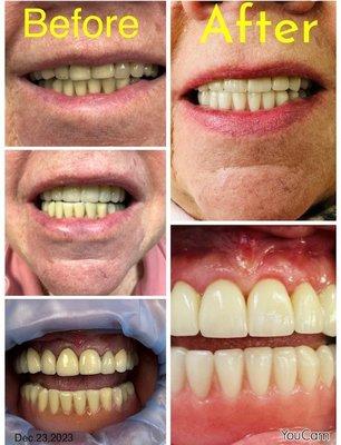 Veneers in Dracut
 Veneers are primarily for appearance and function, but they can't improve the function of teeth that are beyond repair.