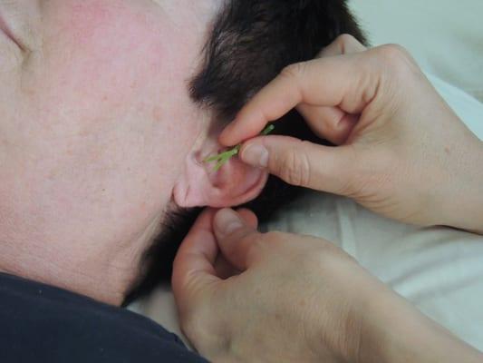 Ear acupuncture.