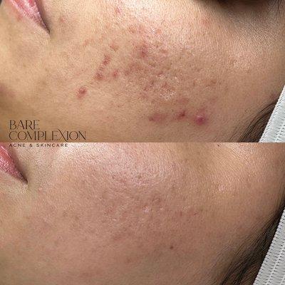 Acne skincare treatments for acne scars located in Ventura,Ca at Bare Complexion Acne & Skincare with Stephanie Vega.