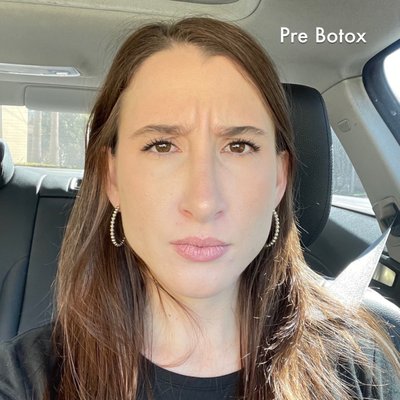 Pre Botox 1/11/23